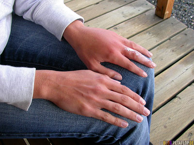 Wasp-Bite-Wespenstich-geschwollene-Hand-swollen-hand-Stardust-Motel-Haines-Junction-Yukon-Canada-DSCN2218.jpg