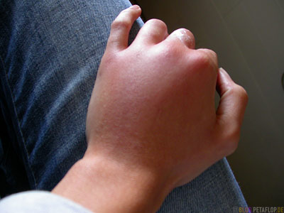 Wasp-Bite-Wespenstich-geschwollene-Hand-swollen-hand-Stardust-Motel-Haines-Junction-Yukon-Canada-DSCN2225.jpg